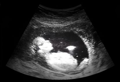 An ultrasound.