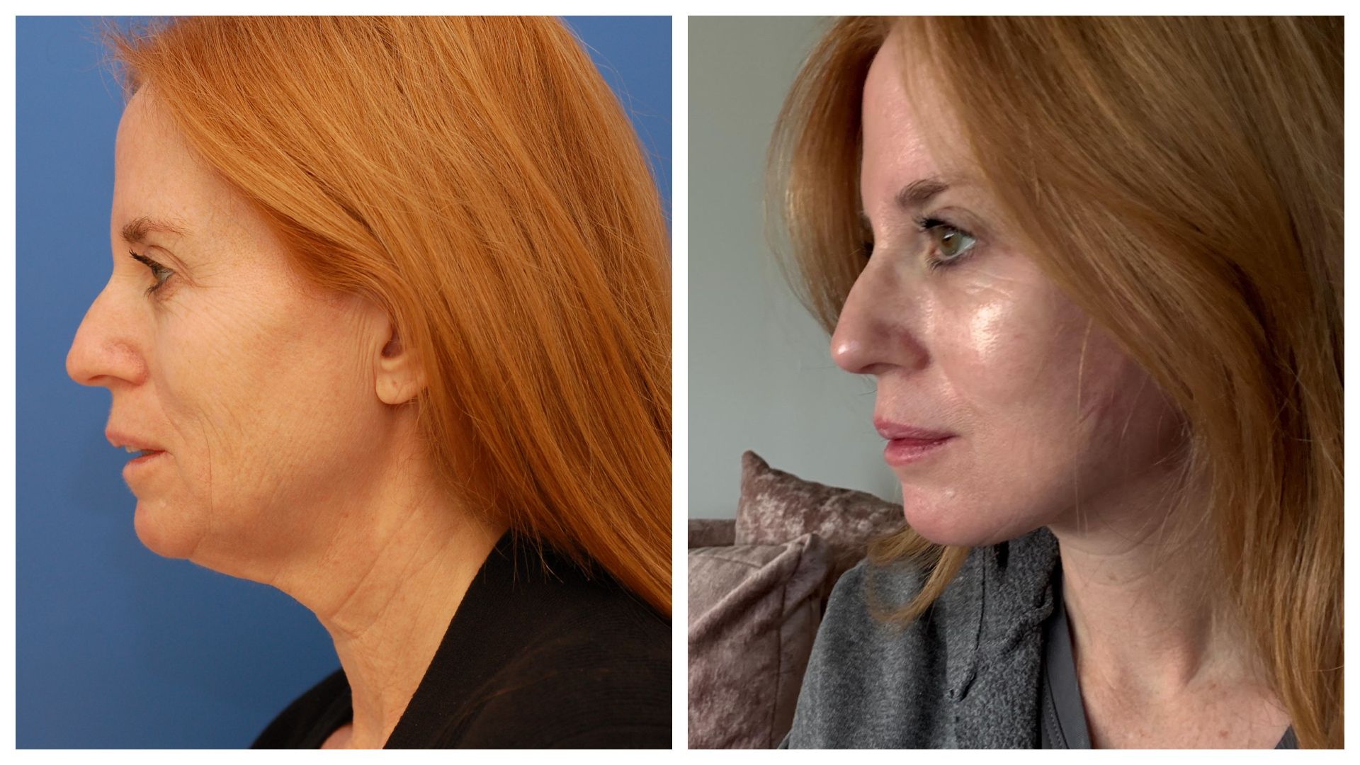 I Spent My Life Savings on a Facelift—It Was the Best Investment In Myself I Ever Made