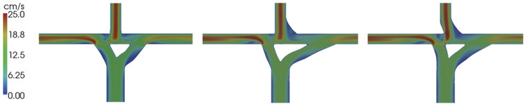 Flow velocity simulation contours in cross-sections of three different vessel geometries after a Fontan procedure, which compensates for a weak heart ventricle in babies. This type of work allows surgeons to plan surgeries.