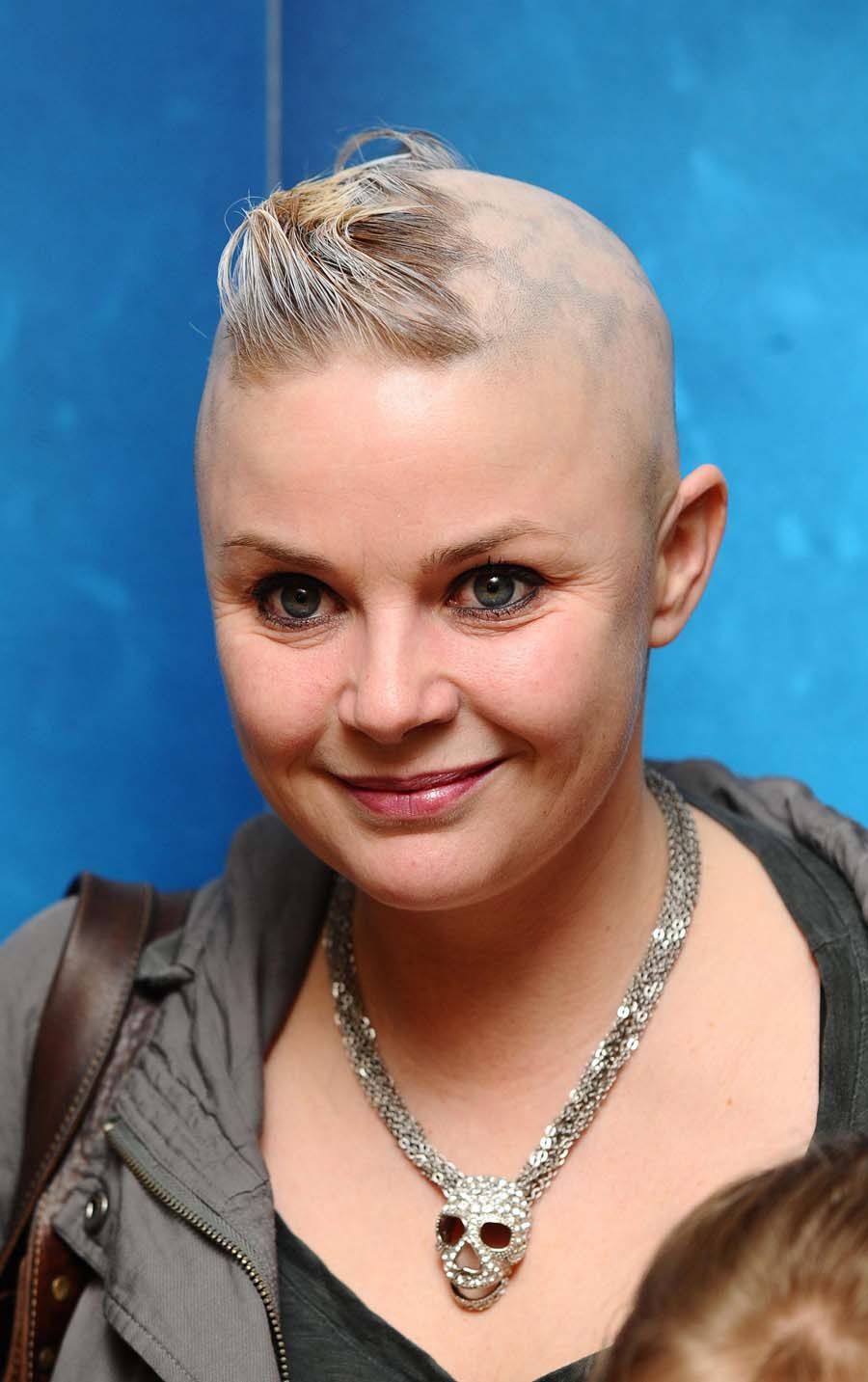 Gail Porter: &#039;I&#039;ll get over hair loss&#039;