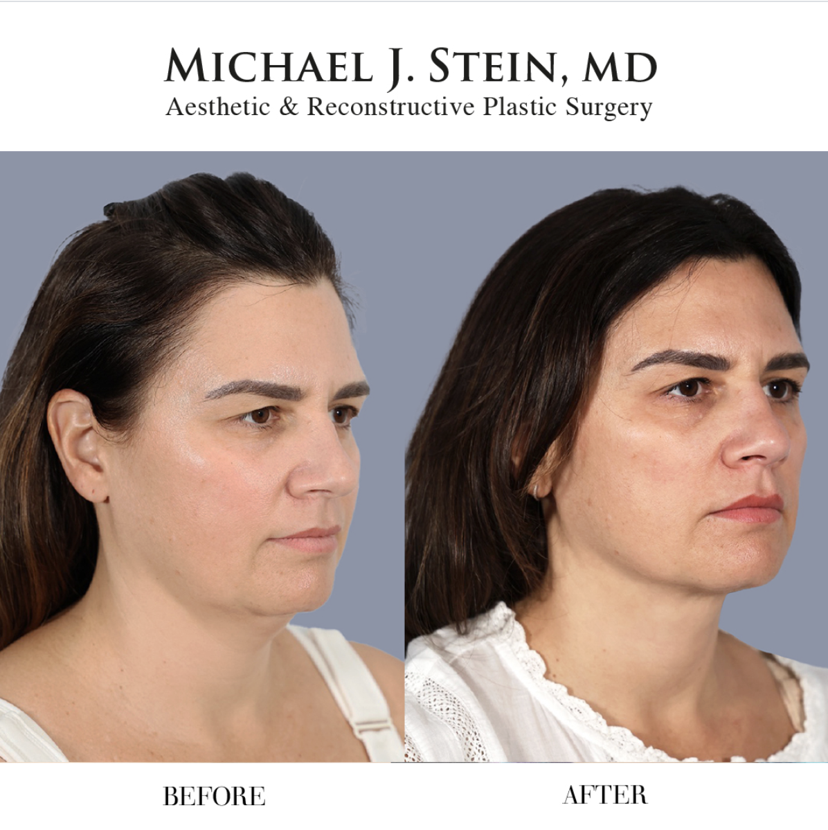 before and after plastic surgery