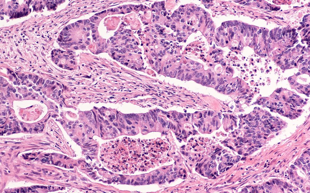 Colon cancer tissue.