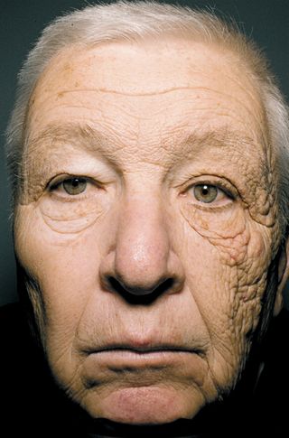 Sun damage on one side of a truck driver's face.