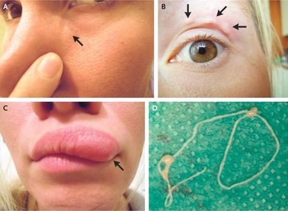 A woman in Russia found a lump on her face that turned out to be a parasitic worm crawling under her skin. The lump first appeared under the woman's eye (Panel A), and then moved above her eye (Panel B), before migrating to her upper lip (Panel C). Doctor