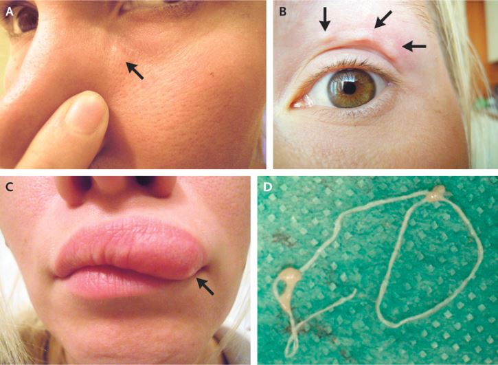 A woman in Russia found a lump on her face that turned out to be a parasitic worm crawling under her skin. The lump first appeared under the woman's eye (Panel A), and then moved above her eye (Panel B), before migrating to her upper lip (Panel C). Doctor