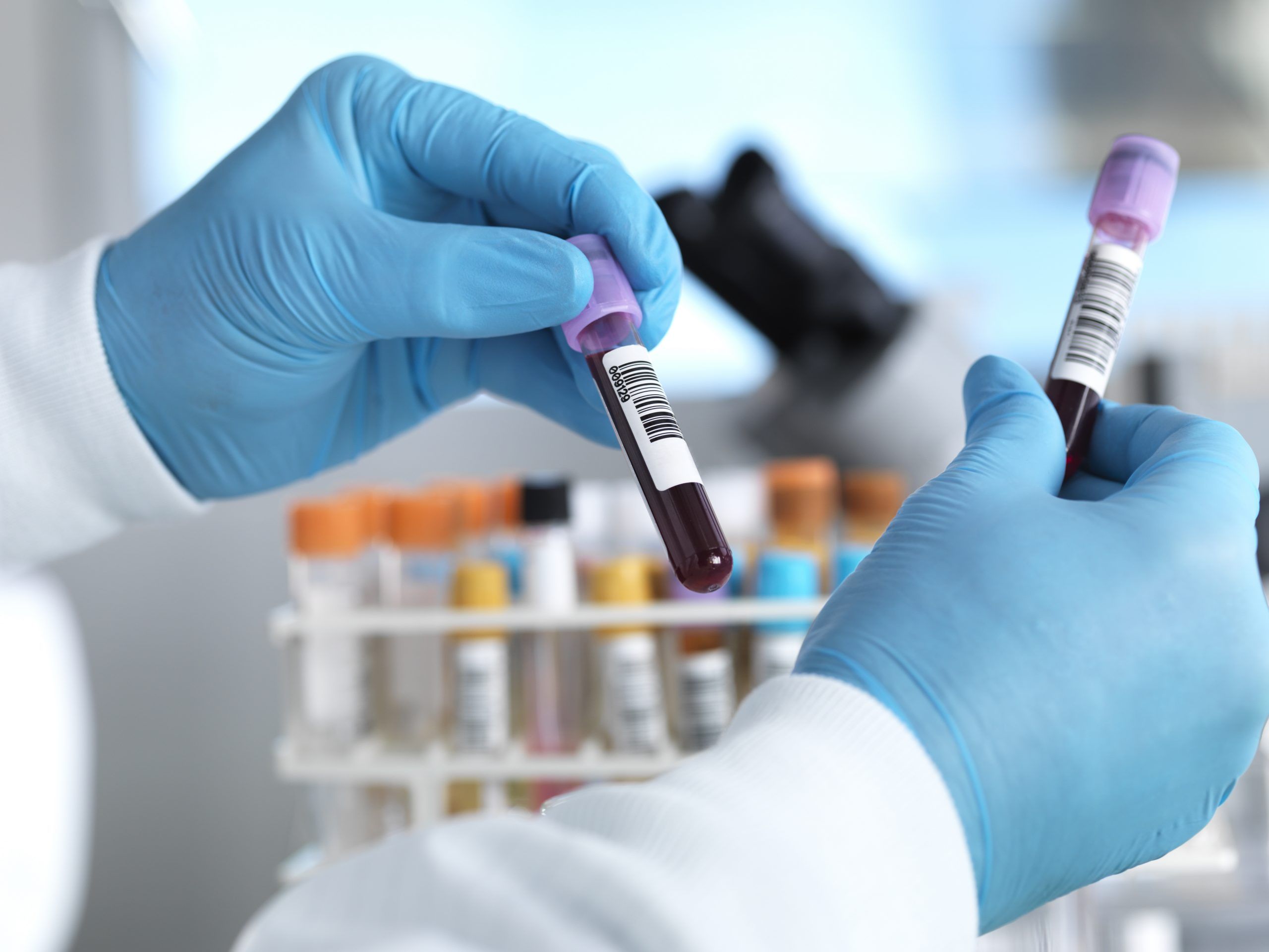 Ca25 A CA 125 blood test can find cancer and increase survival rates for ...