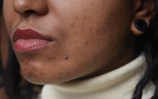 Woman-with-acne-from-eating-to-much-sugar-