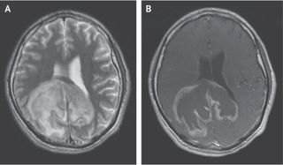 A large mass in a man's brain was due to an infection with the parasite Trypanosoma cruzi.