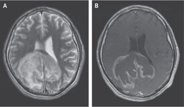 A large mass in a man&#039;s brain was due to an infection with the parasite Trypanosoma cruzi.