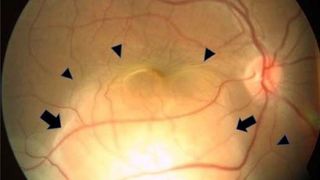 Woman’s sudden blindness in 1 eye revealed hidden lung cancer