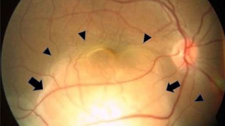 Close-up retinal image of the patient's eye. Red blood vessels can be seen branching from a focal point in the mid-right-hand-side of the image. Black arrows point to the cancerous lesion and retinal detachment. The image of the eye is a circle shape and the eye appears to be a yellow color. There is a black background.