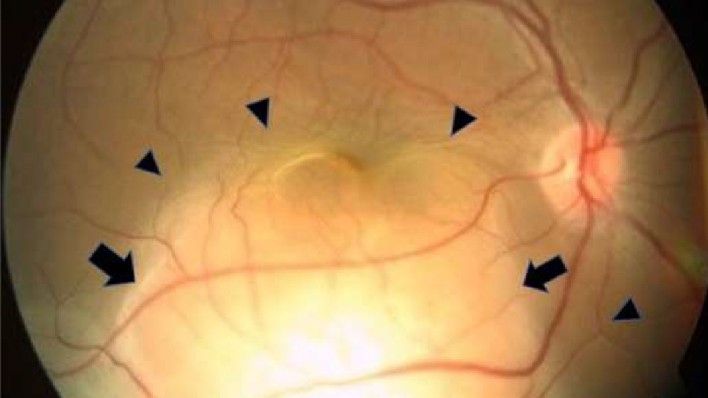 Close-up retinal image of the patient&#039;s eye. Red blood vessels can be seen branching from a focal point in the mid-right-hand-side of the image. Black arrows point to the cancerous lesion and retinal detachment. The image of the eye is a circle shape and the eye appears to be a yellow color. There is a black background.