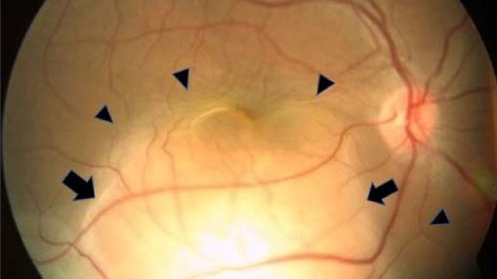 Woman's sudden blindness in 1 eye revealed hidden lung cancer