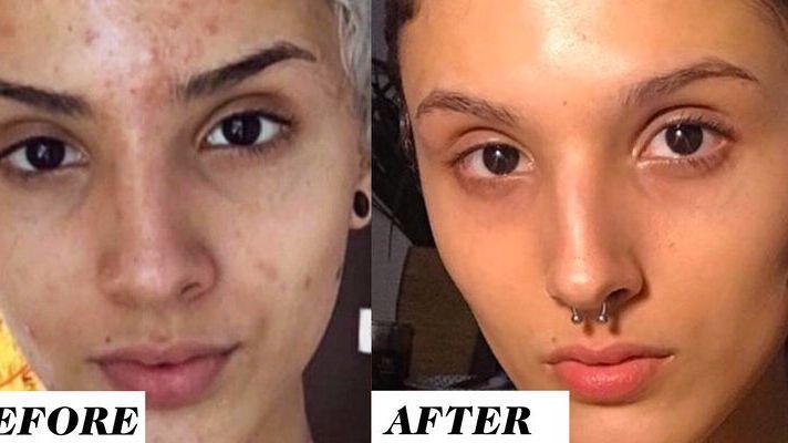 This Woman s Before and After Retinol Results Are Going Viral On Reddit 