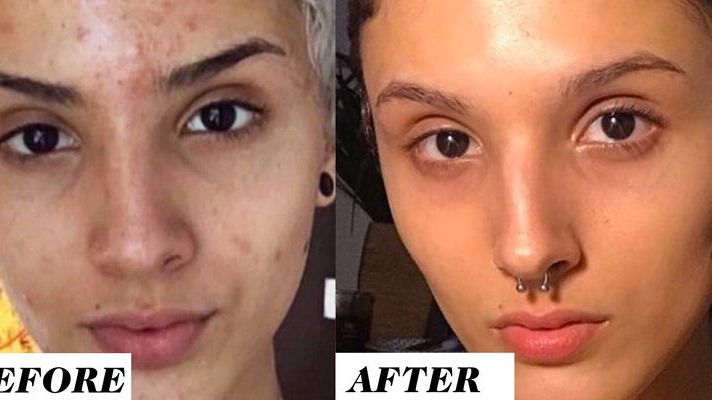 This Woman'S Before-And-After Retinol Results Are Going Viral On Reddit |  Marie Claire