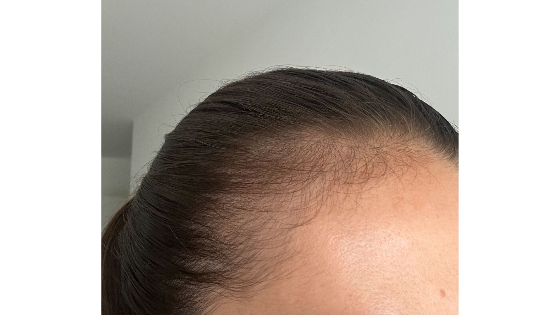 Before image of Sennen's hairline