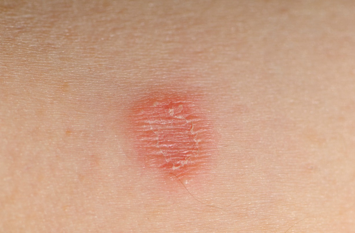 Does Ringworm Live On Furniture at Jordan Brannan blog