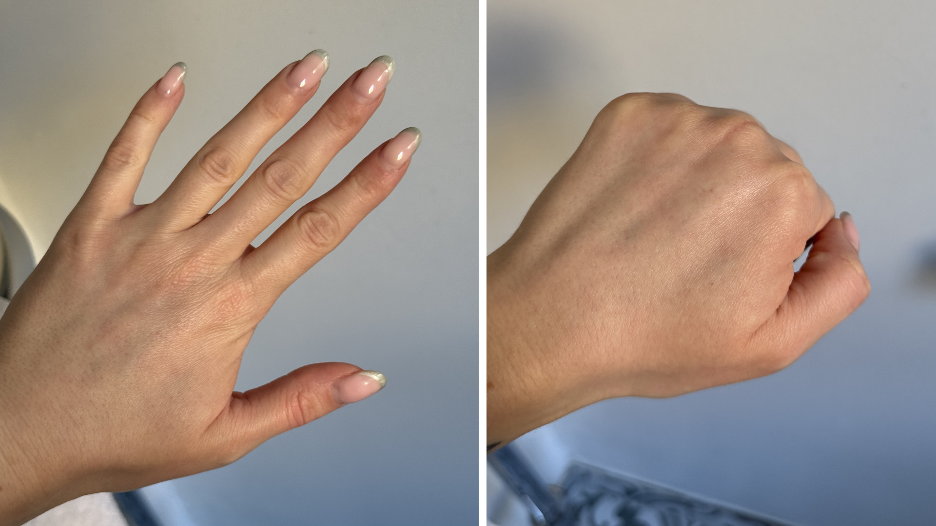 Lucy's hands a week after her second session of polynucleotides for hands