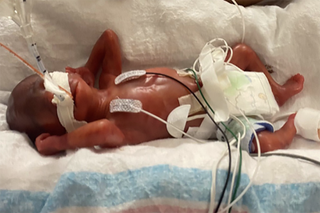 Curtis Means is the most premature baby in the world to survive.