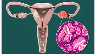 A diagram of ovaries and ovarian cancer