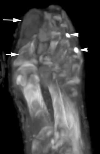 A CT image of the left foot of Ramesses III.