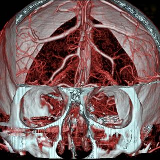 A magnetic resonance imaging scan shows the blood vessels of the brain, a technique surgeons use to find aneurysms.