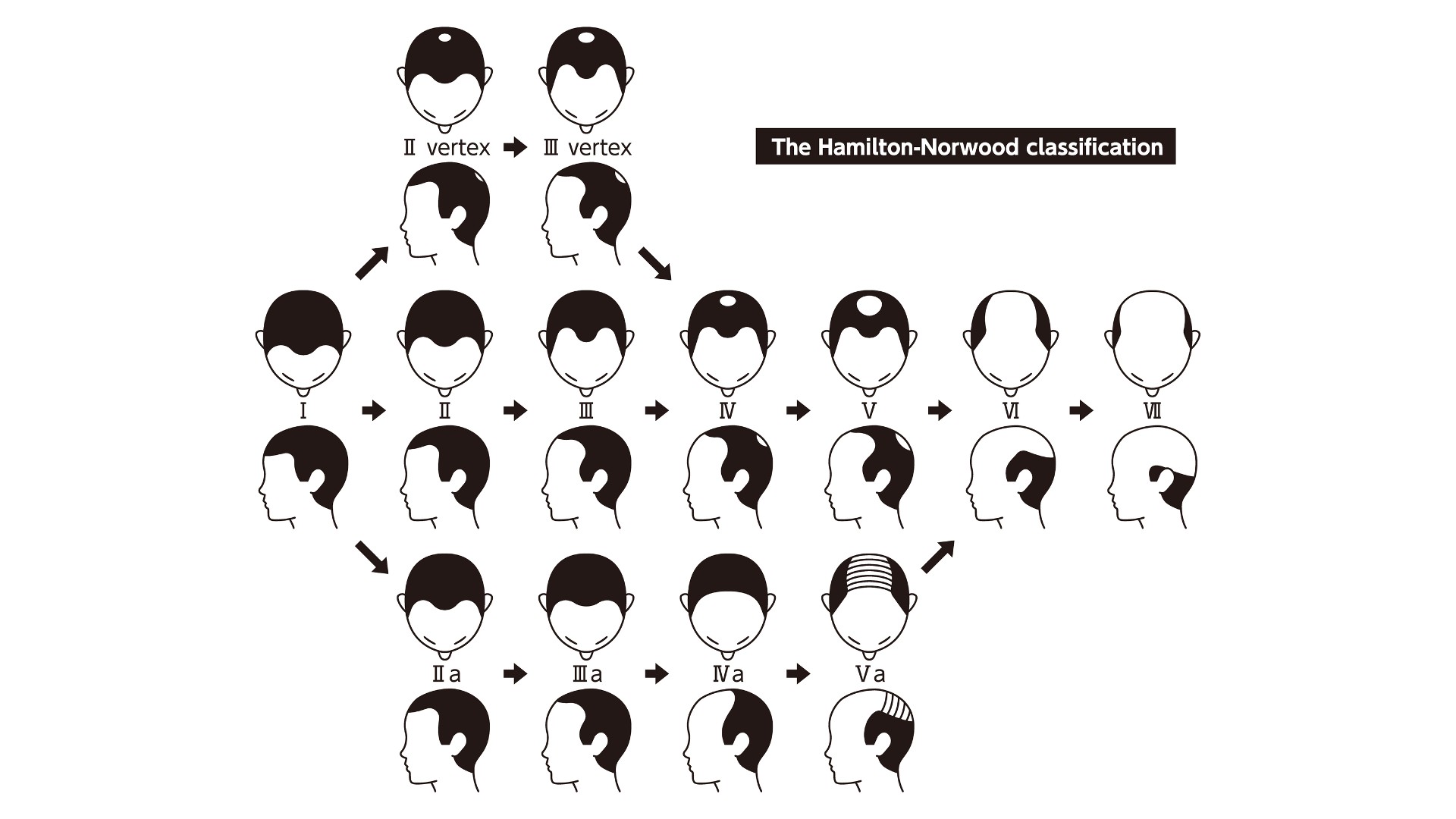 बालों के झड़ने के चरणों और पुरुष सिर पर चित्रित गंजापन के प्रकार की सूचना चार्ट।