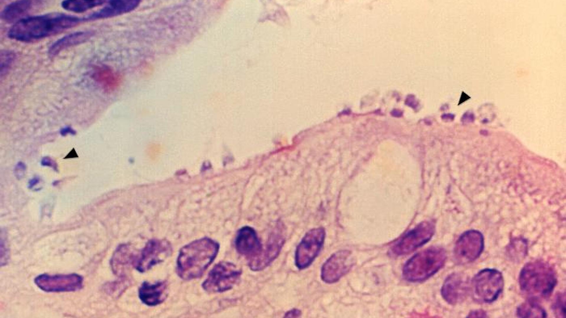 This photomicrograph show small intestine tissues samples in a case of the parasitic disease cryptosporidiosis