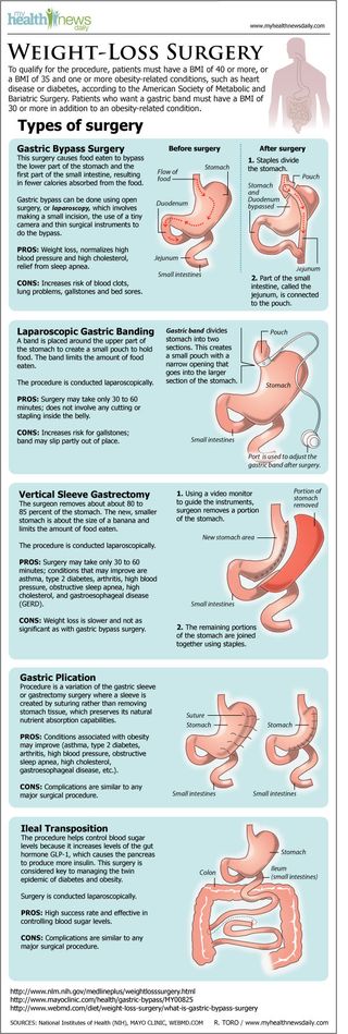 Types of Weight Loss Surgery Infographic