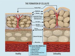 a diagram showing how cellulite develops