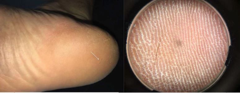 A man&#039;s foot pain turned out to be due to a rare condition in which a hair strand becomes embedded in the skin. Above, an image of the hair strand in the man&#039;s foot (right, arrow), and a magnified view of the hair (left). 