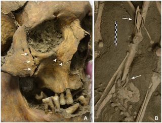 The oldest individual (between 40 and 50 years old) among the dead in the mass grave had fractures to the right cheekbone and the jawbone (A). The fracture to the right femur of another individual was likely associated with a fall, while a gunshot caused 