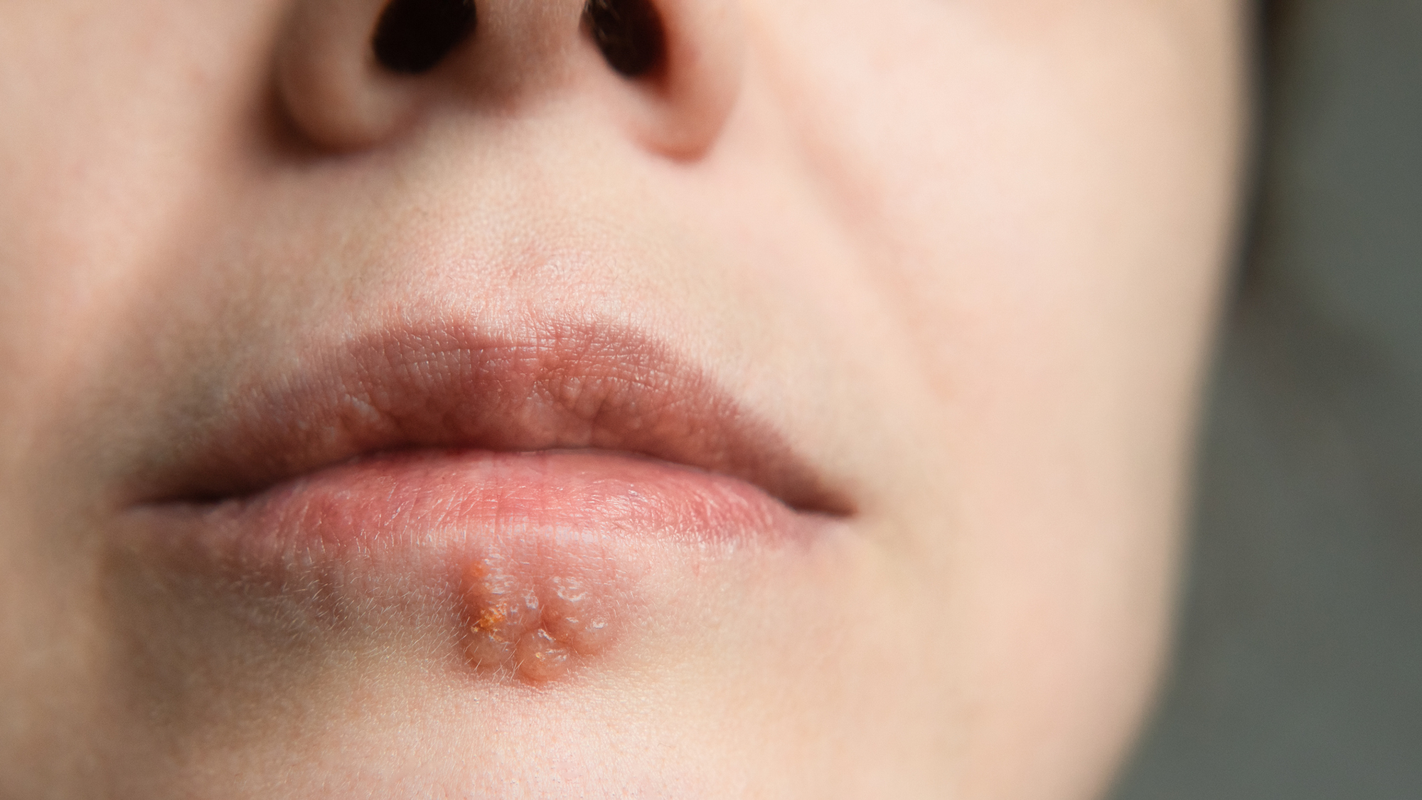 A close up of a woman's lip with a cold sore underneath