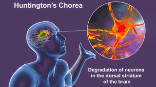 Diagram showing an illustration of a person on the left-hand side who has their left arm raised up. A line points from the brain to a pop-out bubble which shows degraded neurons. Underneath the bubble is a caption that reads "Degradation of neurons in the dorsal striatum of the brain." At the top of the image is a title that reads "Huntington's Chorea."