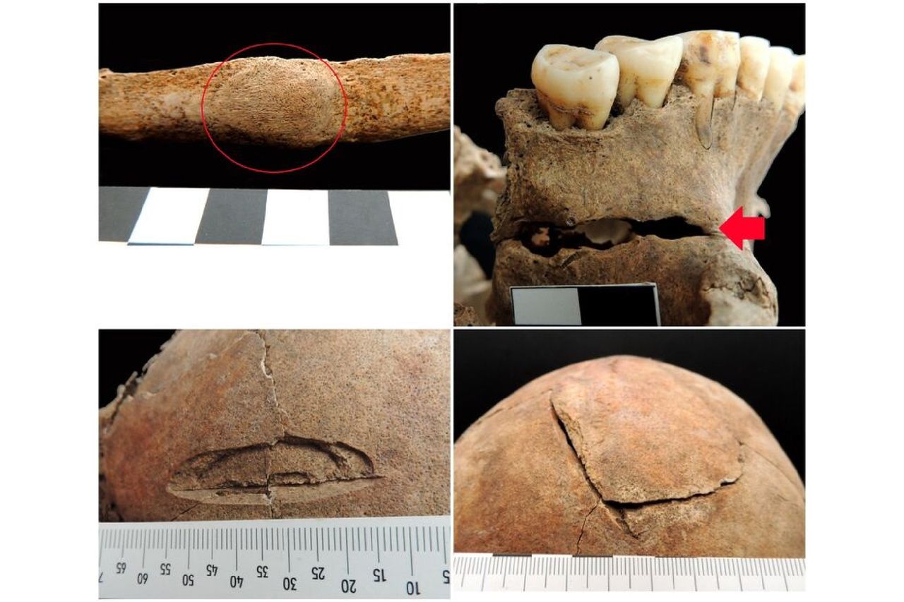 Four close-ups of injuries on the skeleton found in the grave