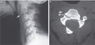 hangman's fracture, broken neck, x-ray