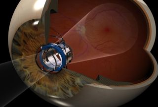 The implantable telescope technology reduces the impact of the central vision blind spot from advanced macular degeneration. The telescope implant projects the objects the patient is looking at on to the healthy area of the light-sensing retina undamaged by the disease.