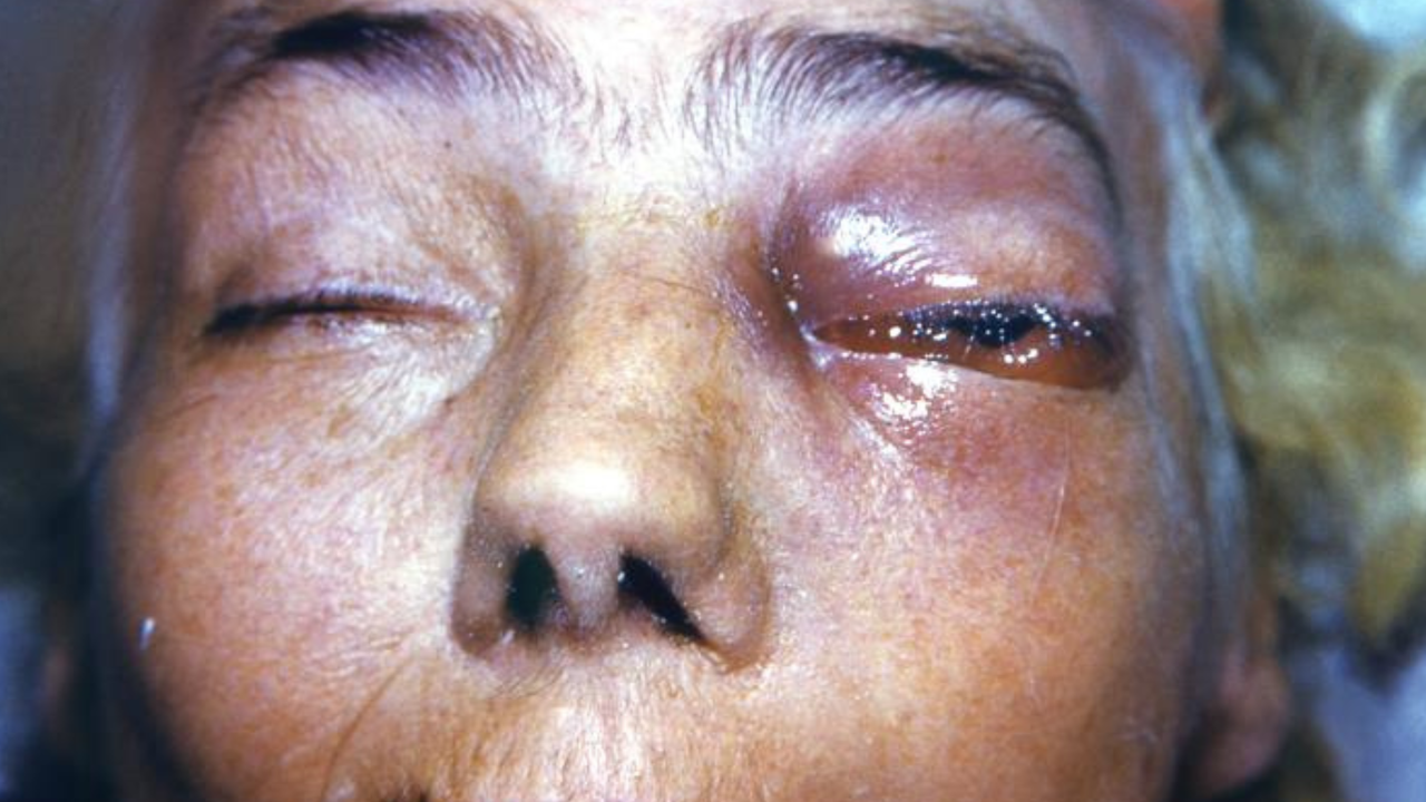 A close-up picture of the face of a person who has mucormycosis. Their left eye is red, swollen and inflammed.
