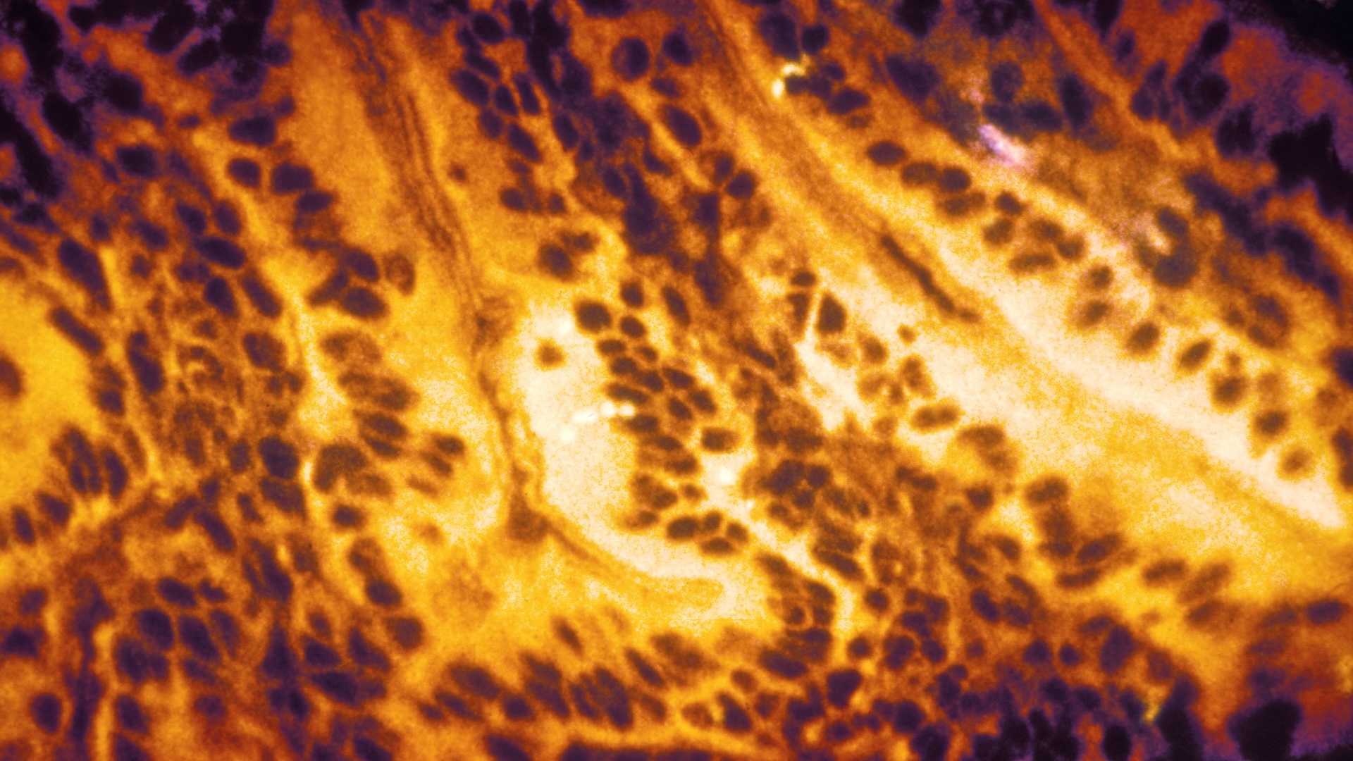 This photomicrograph reveals some of the histopathologic changes found in an intestinal tissue specimen indicative of first-stage shigellosis.