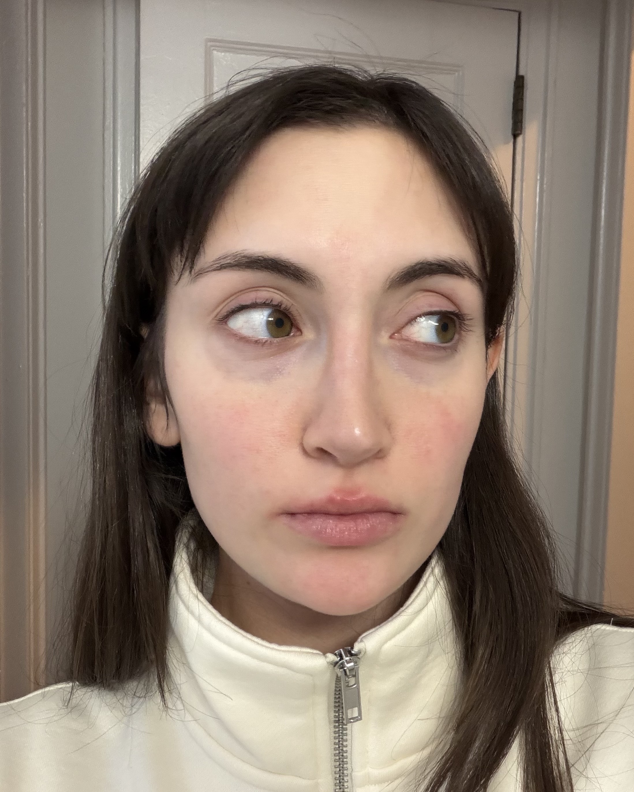 Alyssa Brascia with irritated skin.