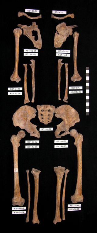 Another individual pieced together from the jumbled remains of about 18 men, who were among those buried in mass grave in Kassel, Germany.