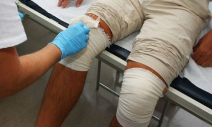 A man gets his bandages changed: Researchers have invented a spray made of donated skin cells that would cure hard-to-heal open wounds. 