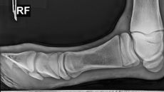 An X-ray showing a horse's leg at a right angle