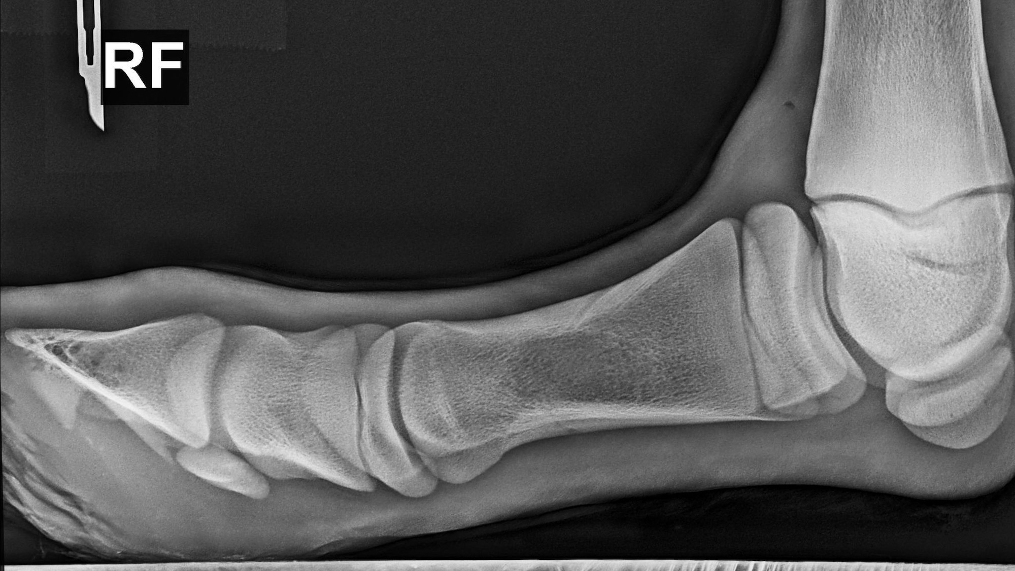 An X-ray showing a horse's leg at a right angle