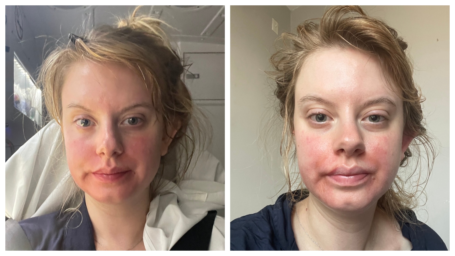 a white woman in a dark blue hoodie with red skin and chemical burn marks