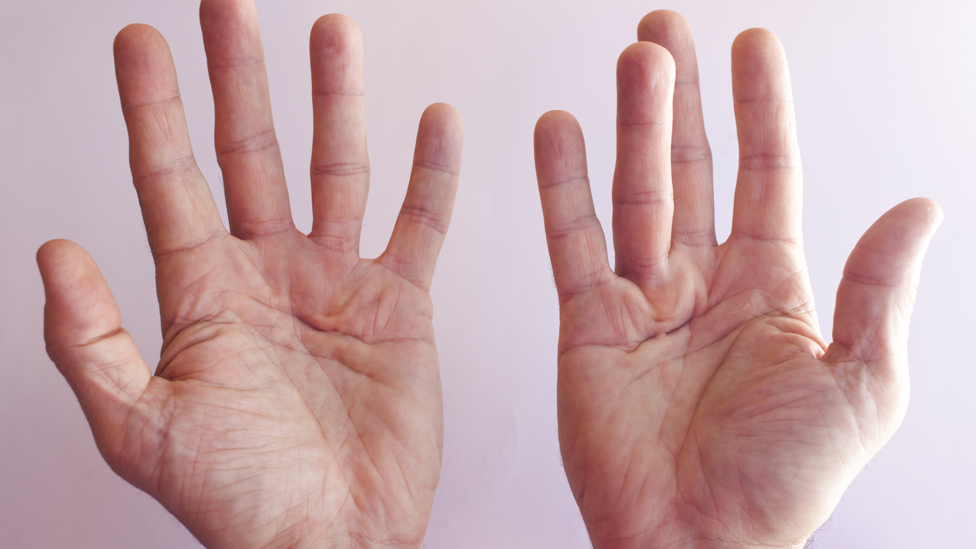 Uma fotografia das mãos de um homem. O dedo anular da mão direita está permanentemente contraído para dentro.