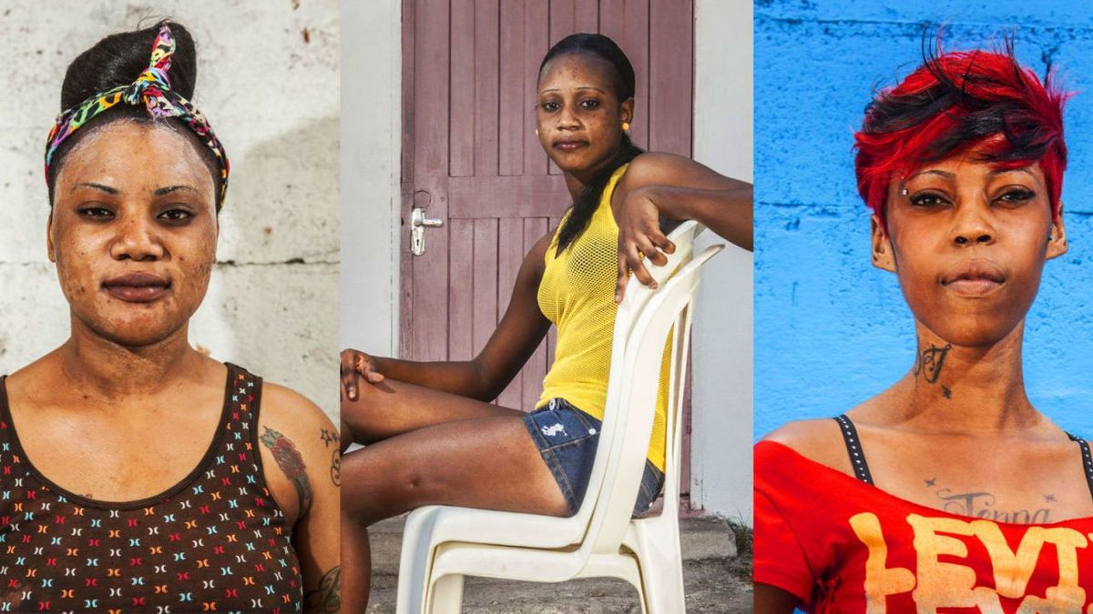 Skin Bleaching - How and Why These Black Women Bleach Their Skin ...