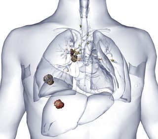Biodigital human lung cancer