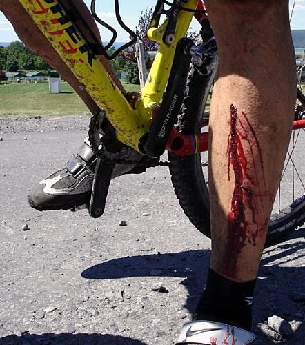 Bontrager blood...