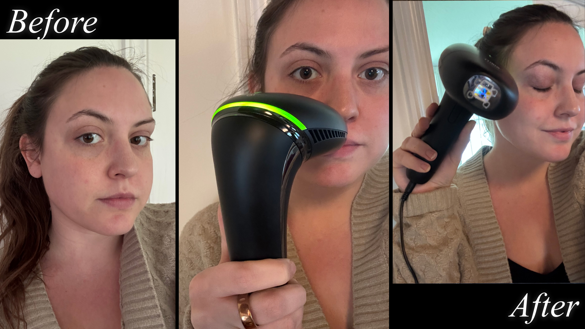 Freelance beauty writer Sophia Vilensky before, during, and after testing the Silk'n 7 IPL machine.